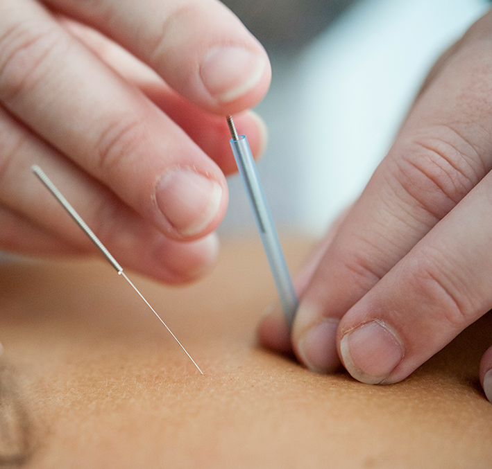 Naprapat Naprapati Uppsala dry needling